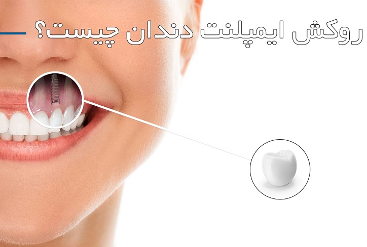 انواع روکش ایمپلنت دندان