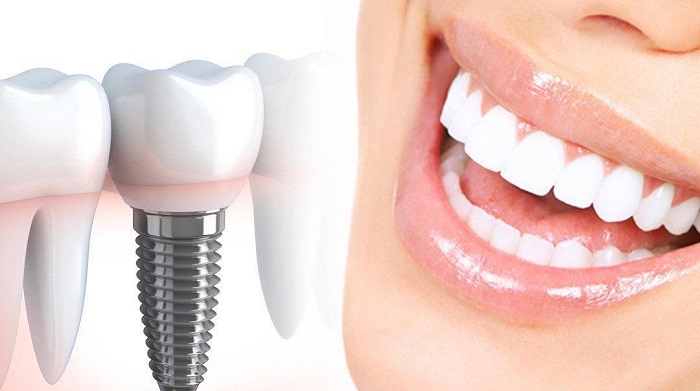 حقایق مهم درباره ایمپلنت دندان 