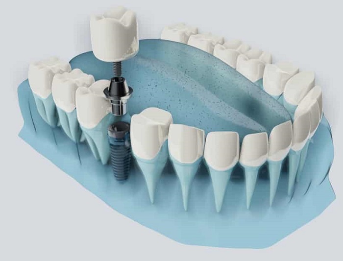 ایمپلنت دندان دیجیتال چیست و چه کاربردی دارد