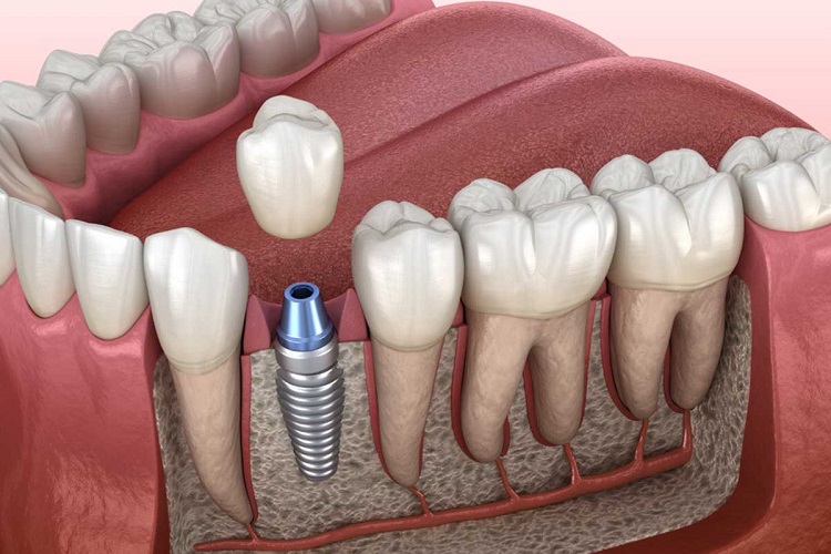 هزینه درمان ایمپلنت دندان