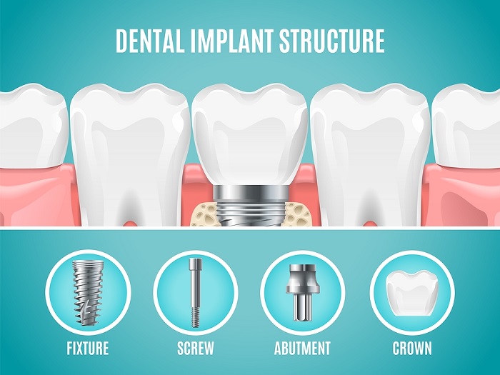 ایمپلنت دندان از چه ساختاری تشکیل شده است