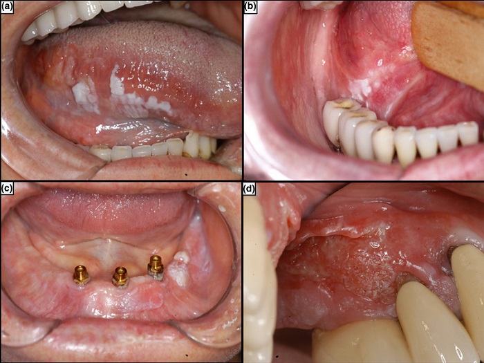 سرطان دهان با کاشت دندان چه ارتباطی دارد