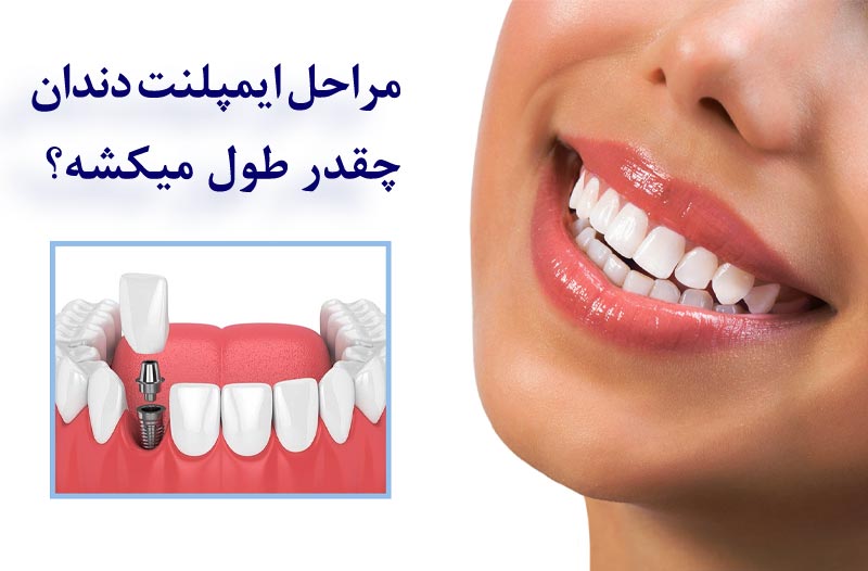 طول عمر ایمپلنت دندان چقدر می باشد