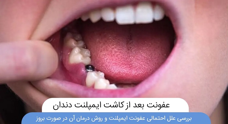 دلایل عفونت ایمپلنت دندان