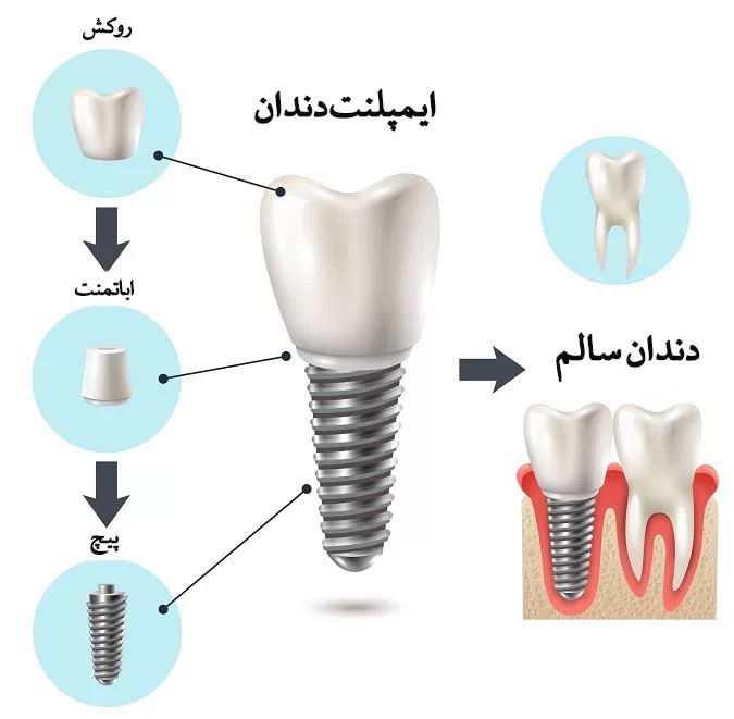 ایمپلنت دندان چگونه انجام میشود