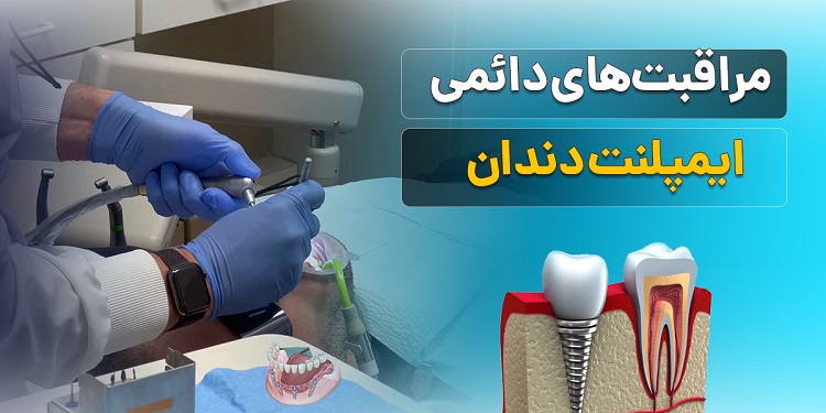 مراقبت های پس از ایمپلنت دندان چگونه است