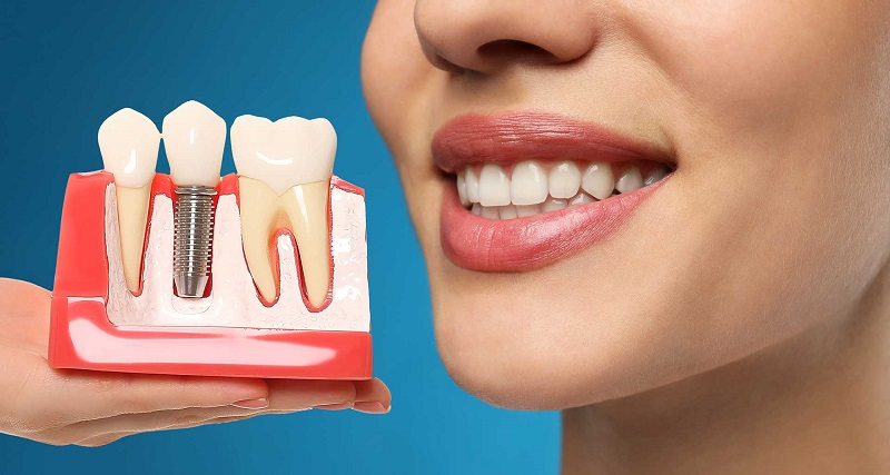 کاشت دندان چیست و چه مراحلی دارد