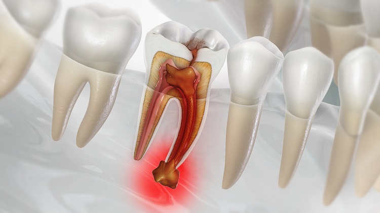 آبسه دندان چیست و چگونه درمان میشود