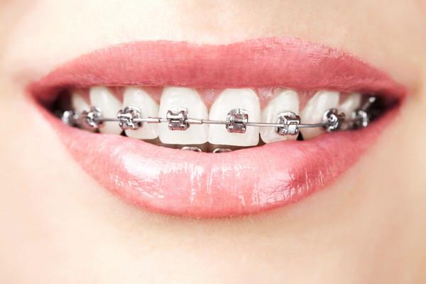 ارتودنسی دندان و چگونه انجام میشود
