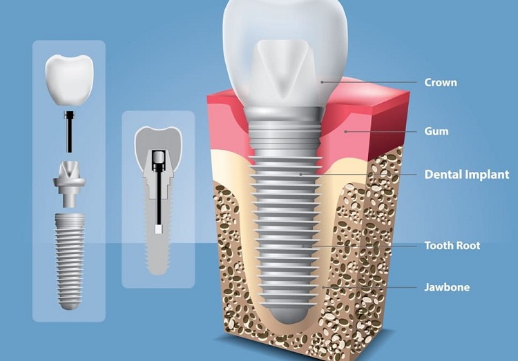 انواع مواد ایمپلنت دندان چه مزایایی دارد
