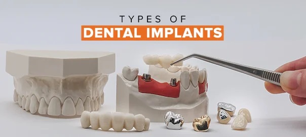 ایمپلنت دندان چگونه کار می کنند و چه مزایایی دارند