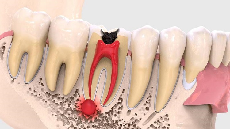 تشخیص علائم کیست دندان و لثه