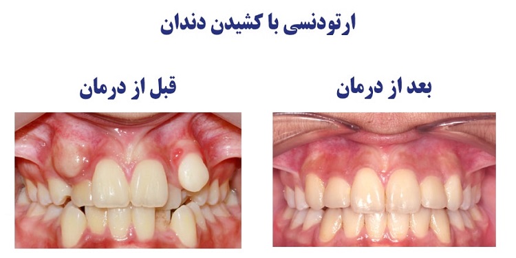 هزینه درمان ارتودنسی در تهران