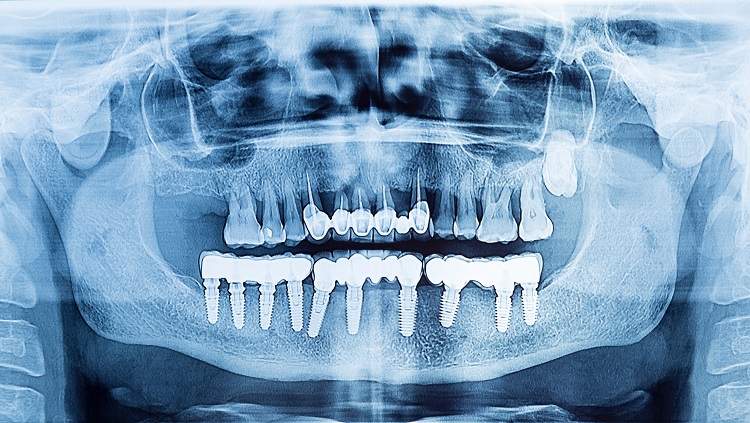 رادیوگرافی ایمپلنت دندان چیست