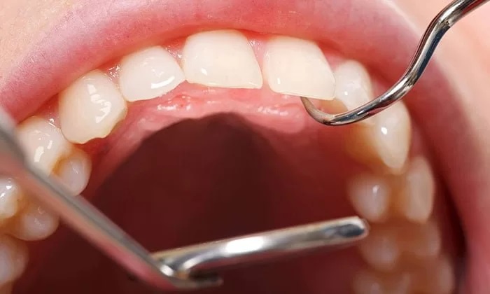 روش برداشتن کیست دندان و لثه