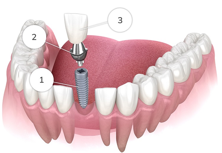 مزایای ایمپلنت دندان کدامند