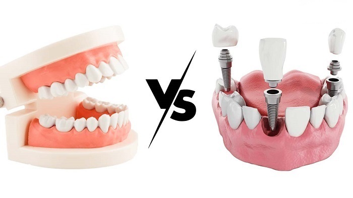 پروتز دندان بهتر است یا ایمپلنت دندان