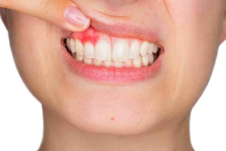 چگونگی پیشگیری از عفونت دندان