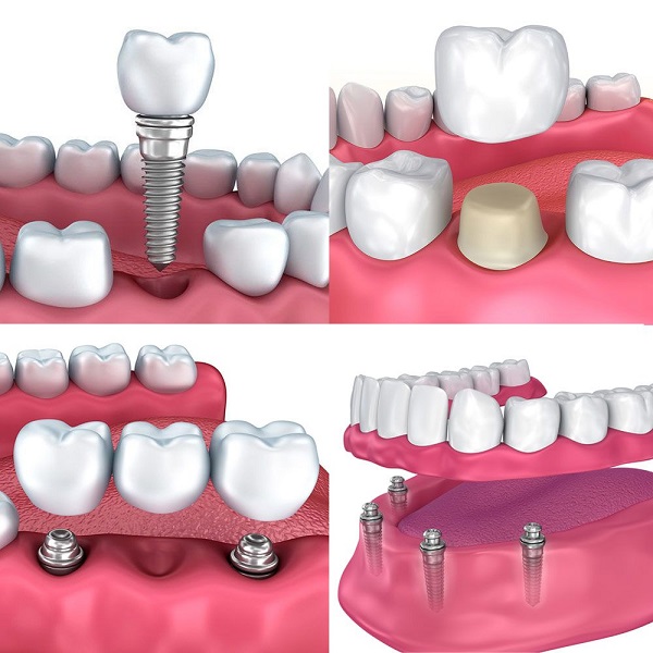 ایمپلنت دندان چه کاربردی دارد