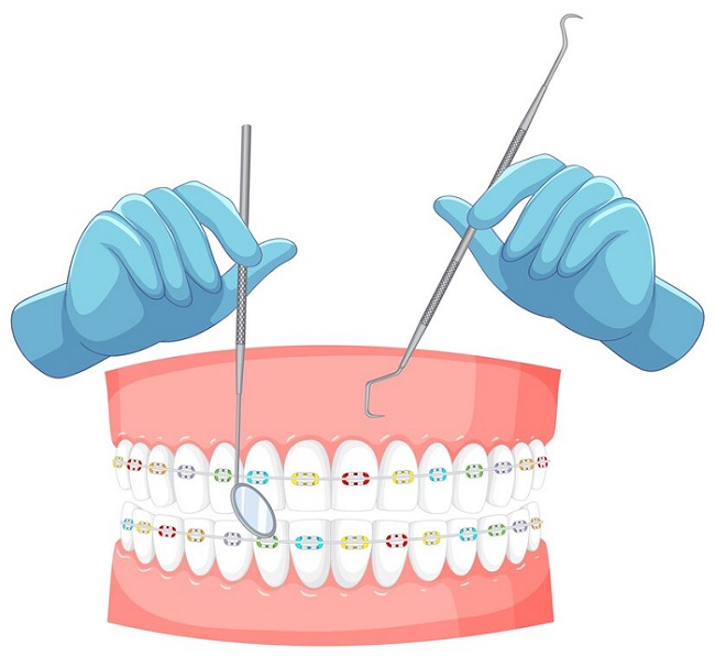 ارتودنسی پشت دندانی چیست 