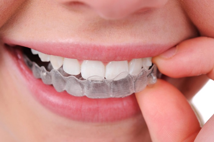 اسپلینت دندان قروچه چیست