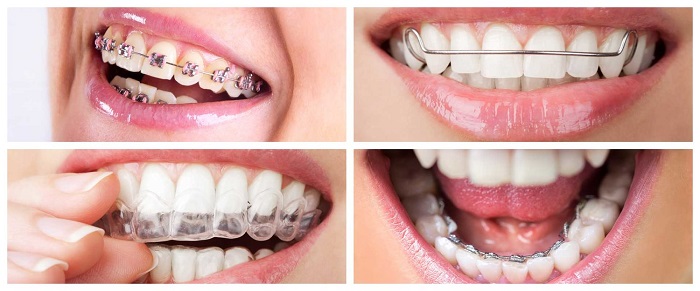 انواع درمان ارتودنسی دندان کدامند