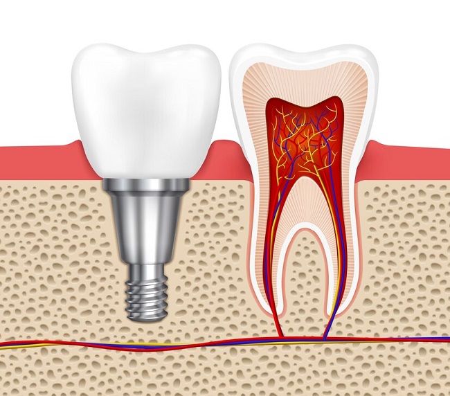 ایمپلنت های دندانی چه مزایایی دارند