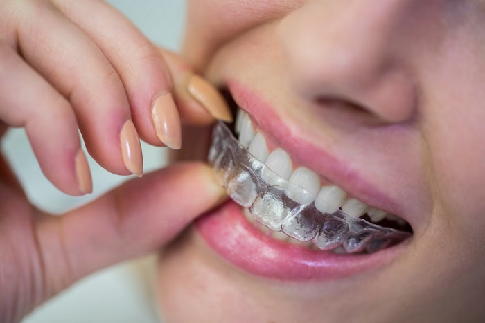 بریس دندان چیست 