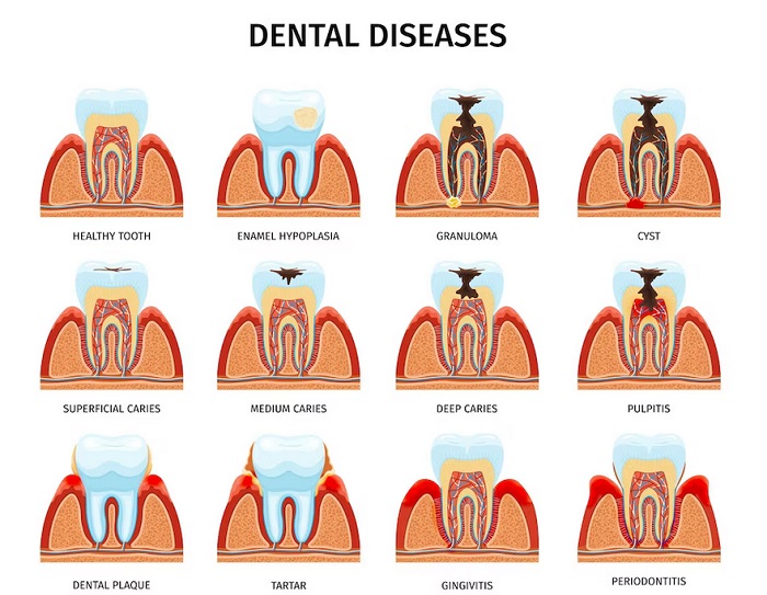 بیماری های دندان کدامند 