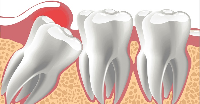 دندان نهفته و درمان آن