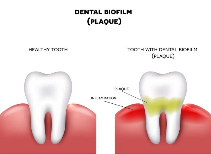 روش های بلیچینگ دندان چگونه است