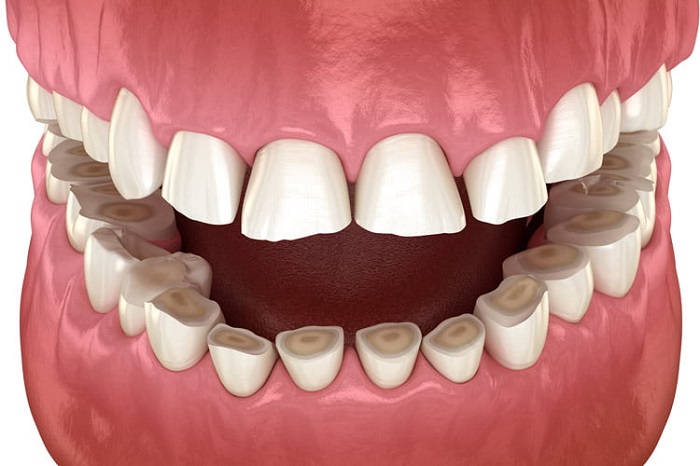 دندان قروچه چه علائمی دارد