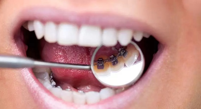 ارتودنسی پشت دندانی چه مزایایی دارد