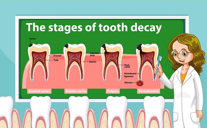 فرسایش دندان چگونه درمان میشود