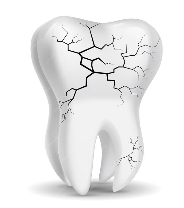 شکستگی دندان و روش های درمان آن