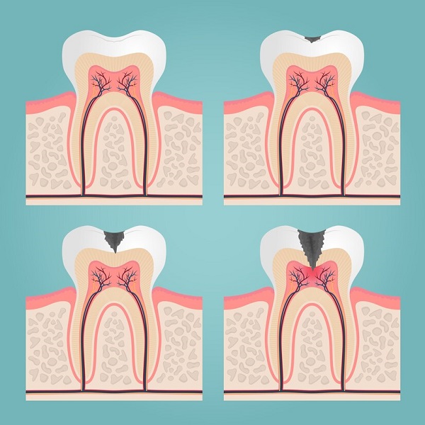 عفونت دندان عقل چه خطراتی دارد