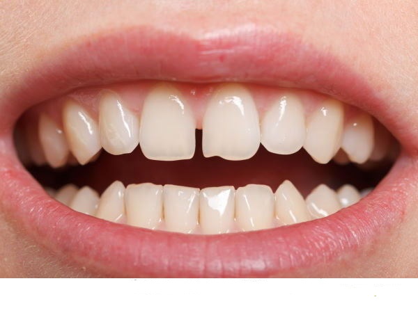 فاصله بین دندان چه دلایلی دارد