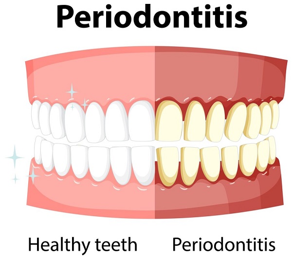 فاصله بین دندان با ارتودنسی چگونه است