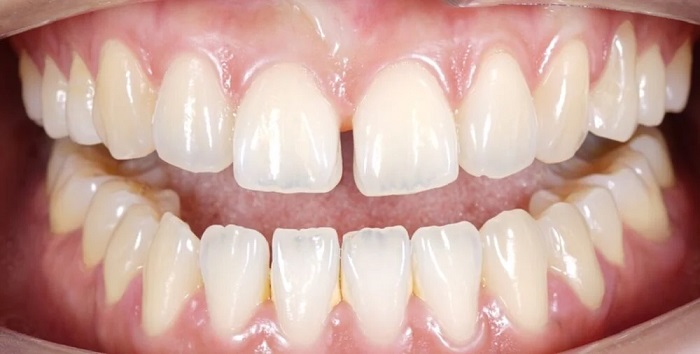 فاصله بین دندان چیست 