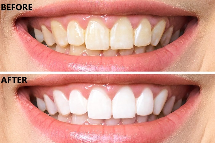 سفید کردن دندان با لیزر چه مزایایی دارد