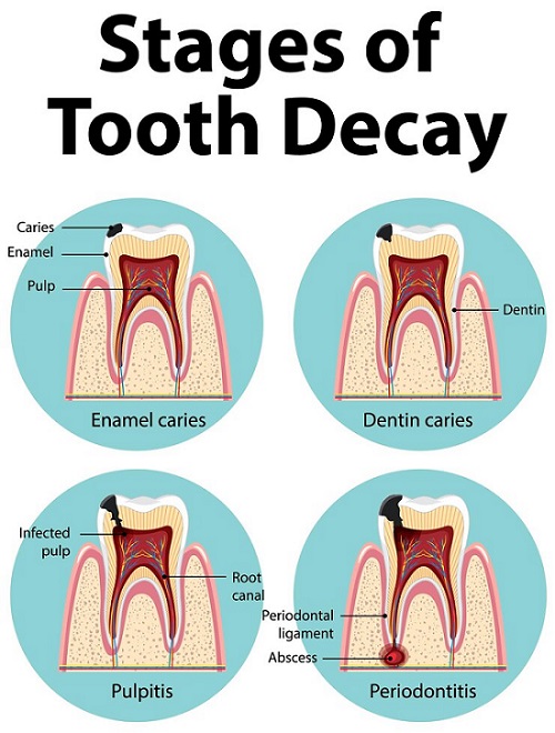 پوسیدگی دندان چیست 