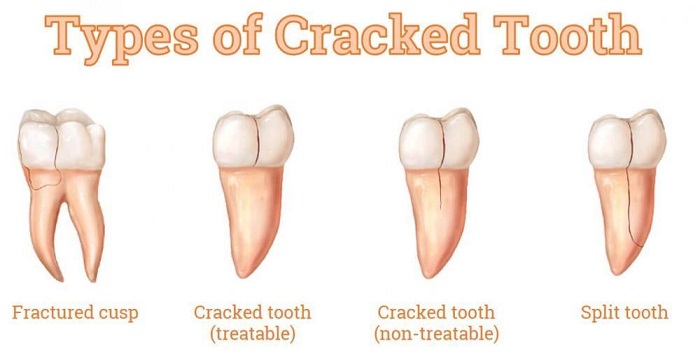 روش های تشخیص ترک خوردن دندان ها کدامند