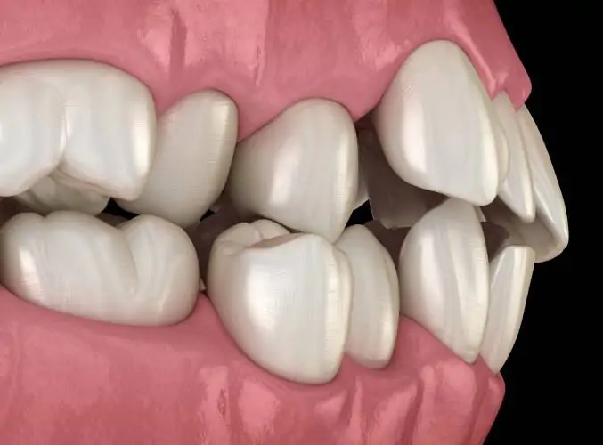 روش های درمان کج شدن دندان ها کدامند