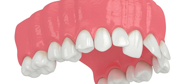 عواقب ناهماهنگی دندان ها از کج شدن دندان چیست