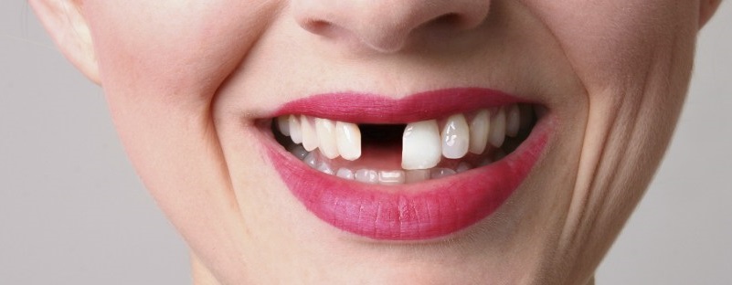 لق شدن دندان و روش های درمان آن