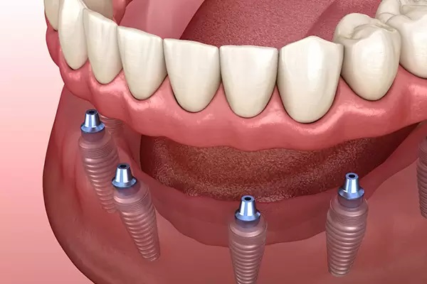 مزایای ایمپلنت دندان برای دندان از دست رفته چیست