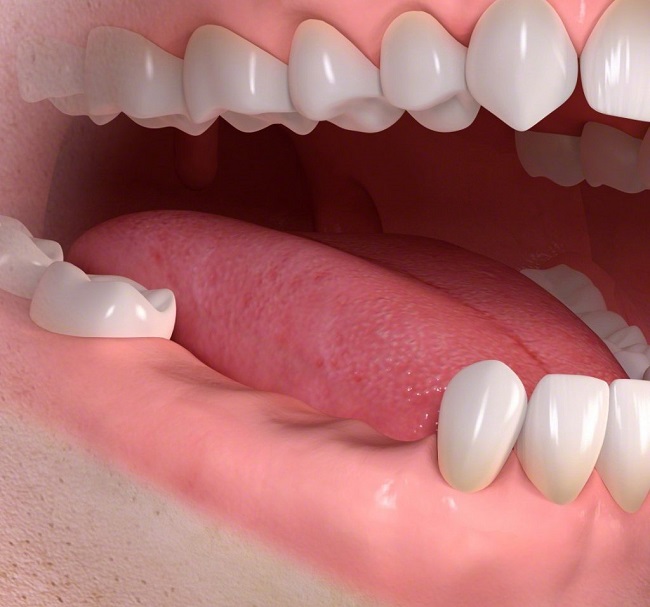 مشکلات ناشی از دست دادن دندان کدامند