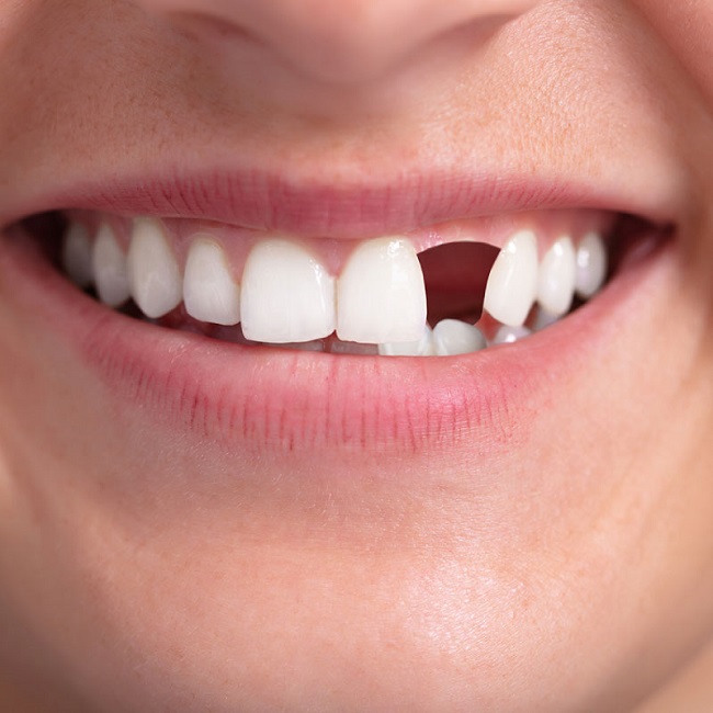 چگونه از لق شدن دندان جلوگیری کنیم
