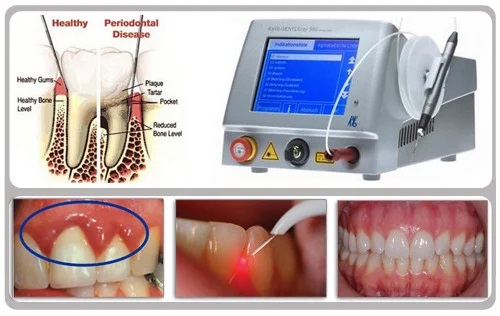 از چه نوع لیزری برای درمان پوسیدگی دندان استفاده میشود و چه کیفیتی دارند