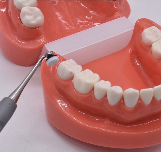 امکان چسباندن کامپوزیت دندان در خانه وجود دارد